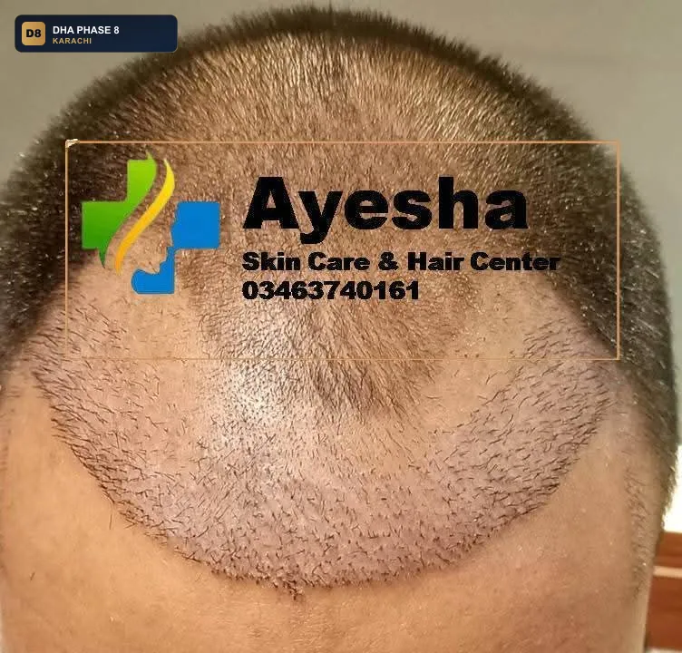 ayesha-skin-care-hair-center-karachi-pakistan-hair-dha-phase-8-karachi