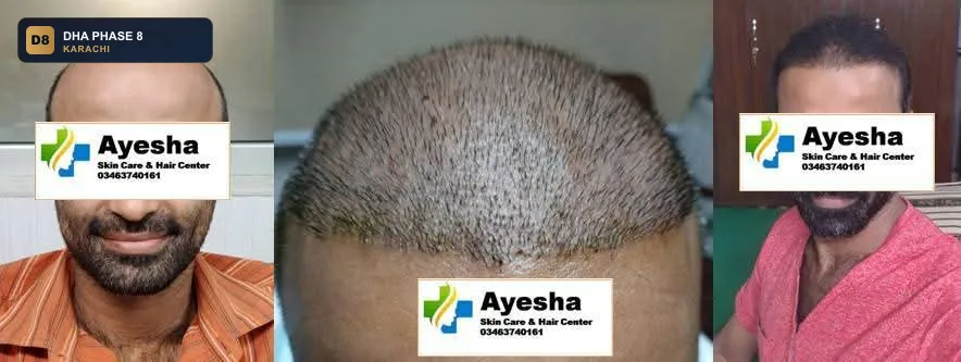 ayesha-skin-care-hair-center-karachi-pakistan-hair-dha-phase-8-karachi thumb 2