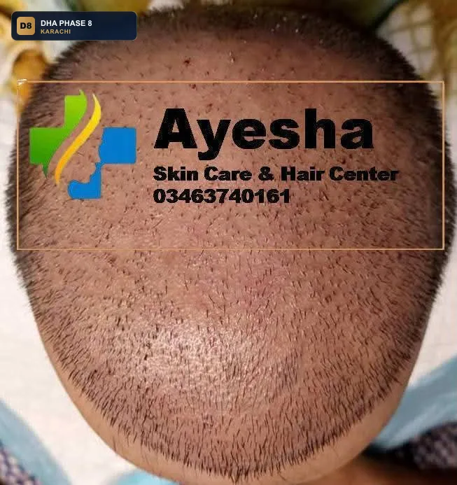 ayesha-skin-care-hair-center-karachi-pakistan-hair-dha-phase-8-karachi thumb 3