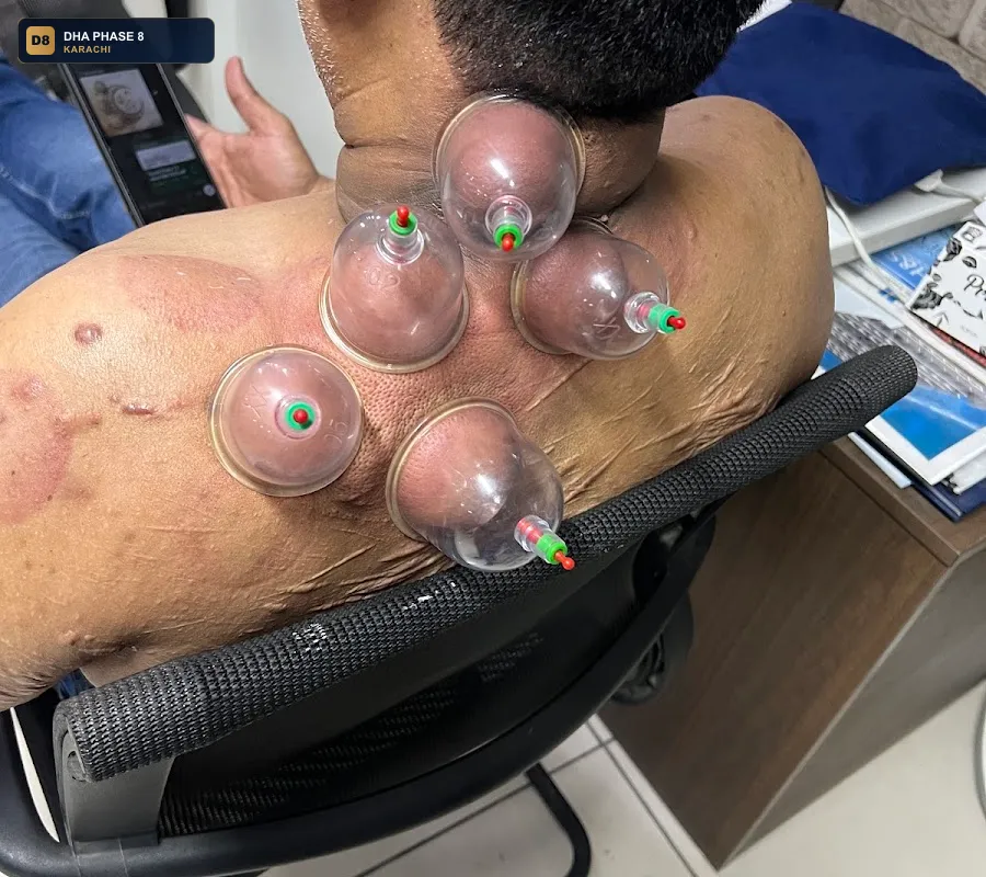 dry-needling-specialist-karachi-dha-phase-8-karachi thumb 2